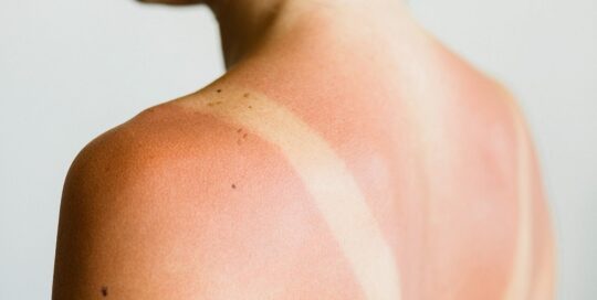 skin sunburn treatment