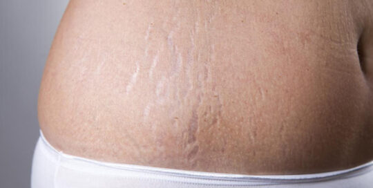 stretch-marks-remove-01-skincarelasercenter