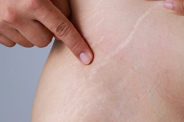 stretch-marks-remove-03-skincarelasercenter