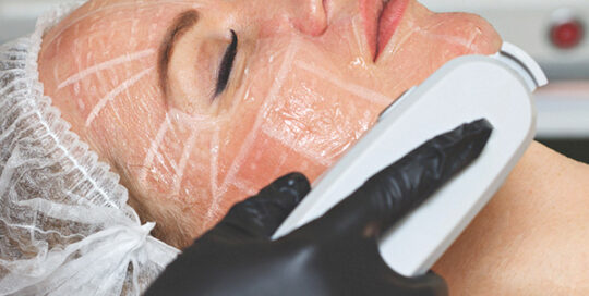 hifu-treatment-02-skincarelasercenter