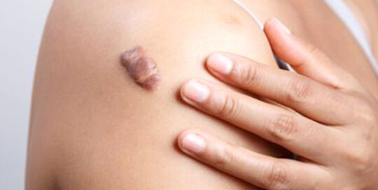 keloid-scar-removal-02-skincarelasercenter