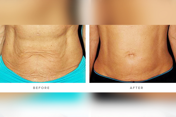 skin-tightening-03-skincarelasercenter