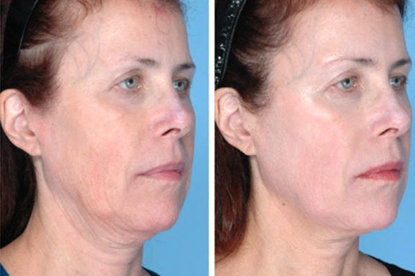 skin-tightening-04-skincarelasercenter