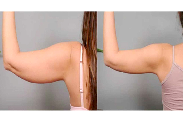 skin-tightening-05-skincarelasercenter