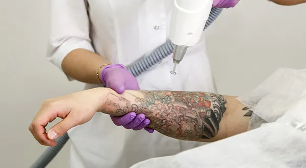 Tattoo Remove Service Tattoo Remove Service