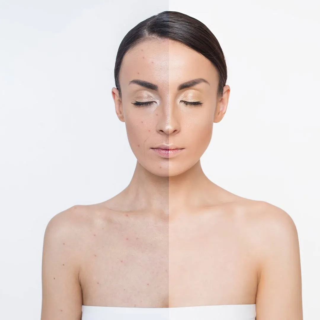 Glutathione Injection Treatment