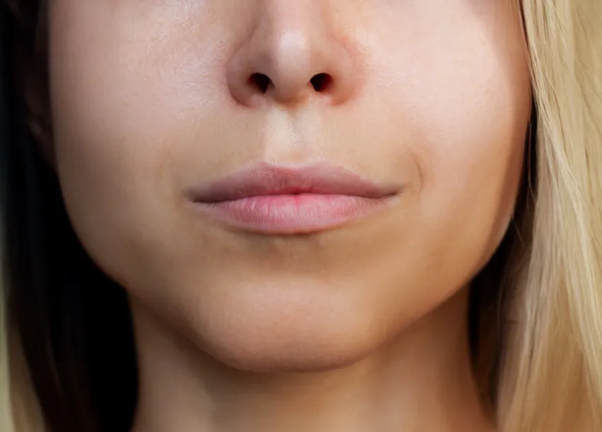 Lip Re-shape By Filler In Bangladesh