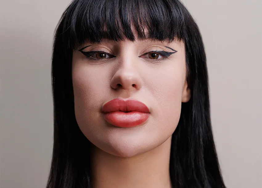 Dermal Fillers Before And After Image