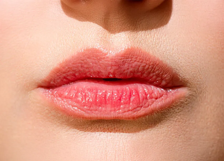 Lip Re-Shape by Filler in Bangladesh
