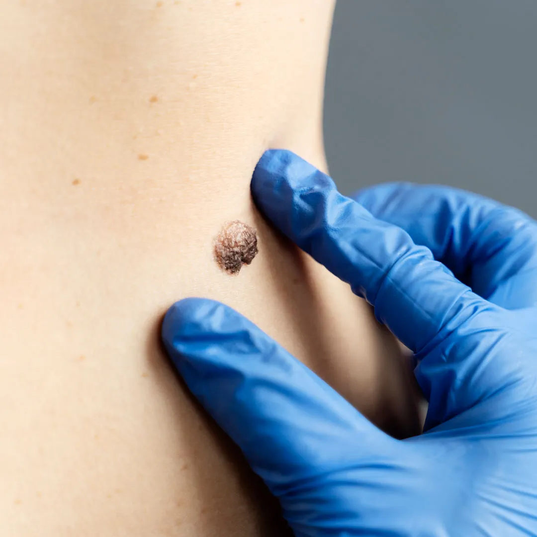 Best Skin Tag Removal Treatment in Dhaka