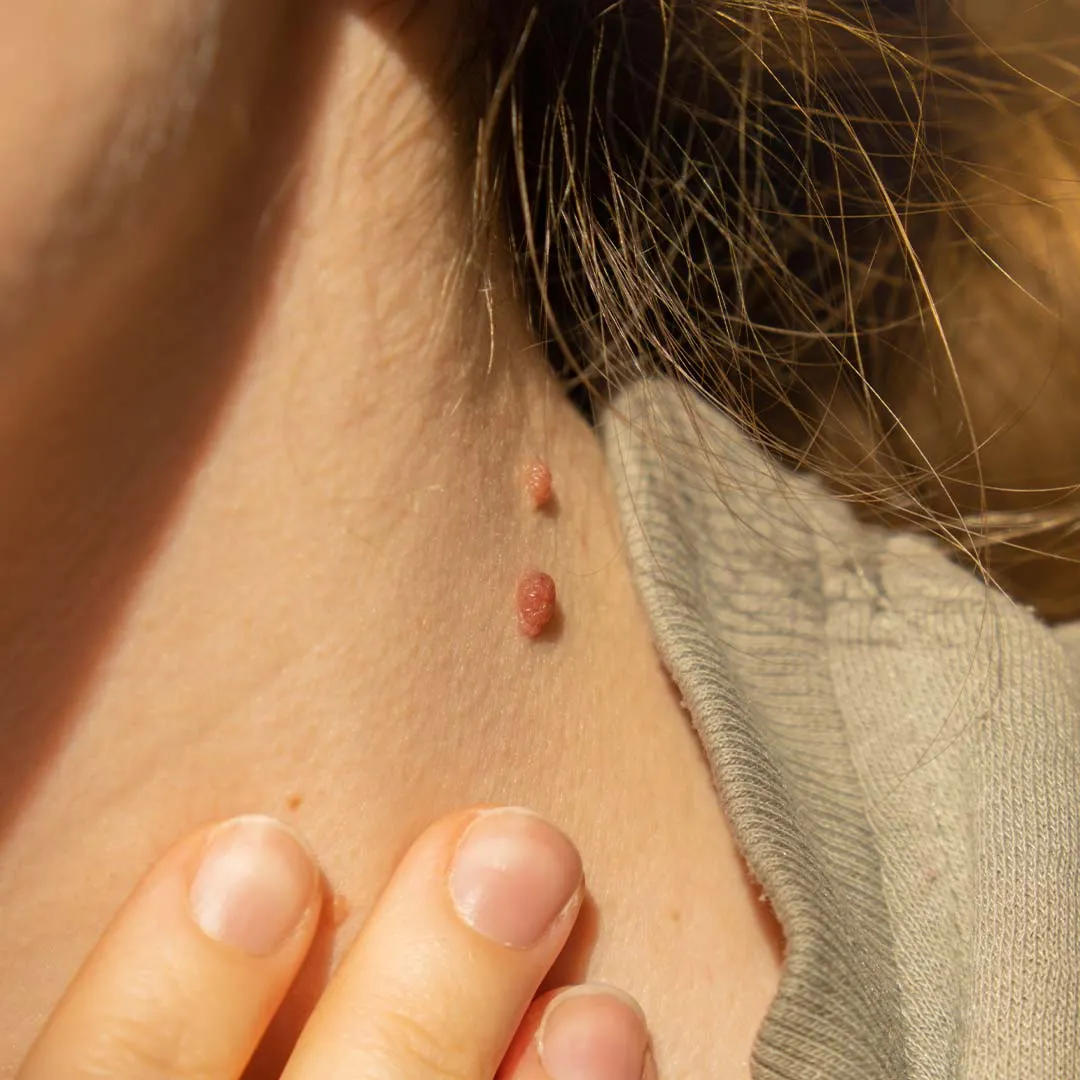 Freckles Removal Treatment