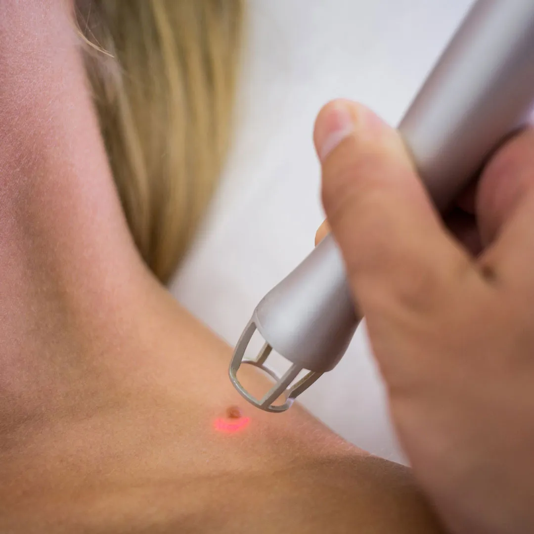 Skin Tag Removal Benefits
