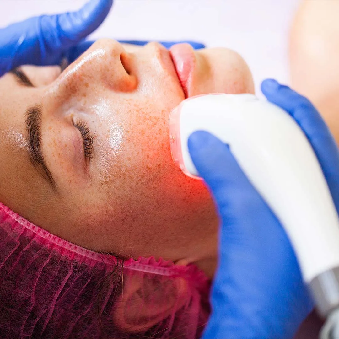 Mole Removal Treatment