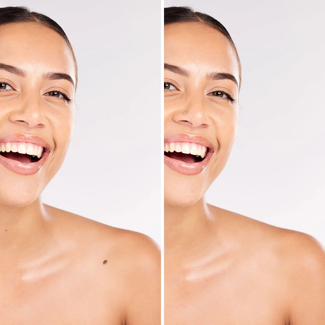 Skin Tag Removal Benefits