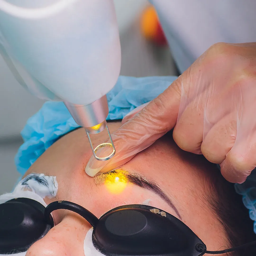 Mole Removal at Dhanmondi Skin and Laser Center