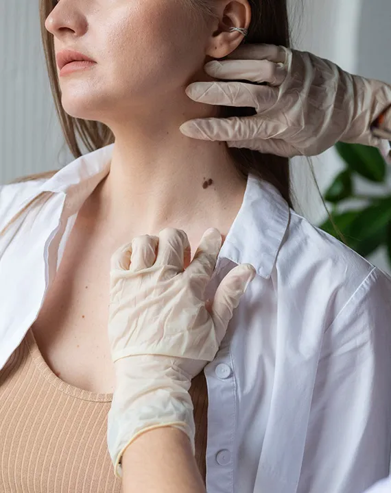 Mole Removal Treatment Mole Removal Treatment