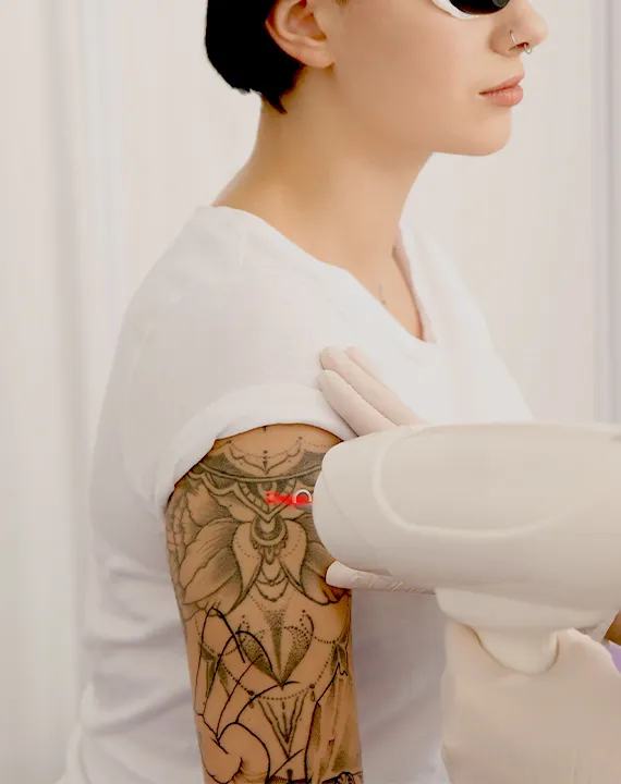 Tattoo Removal Tattoo Removal