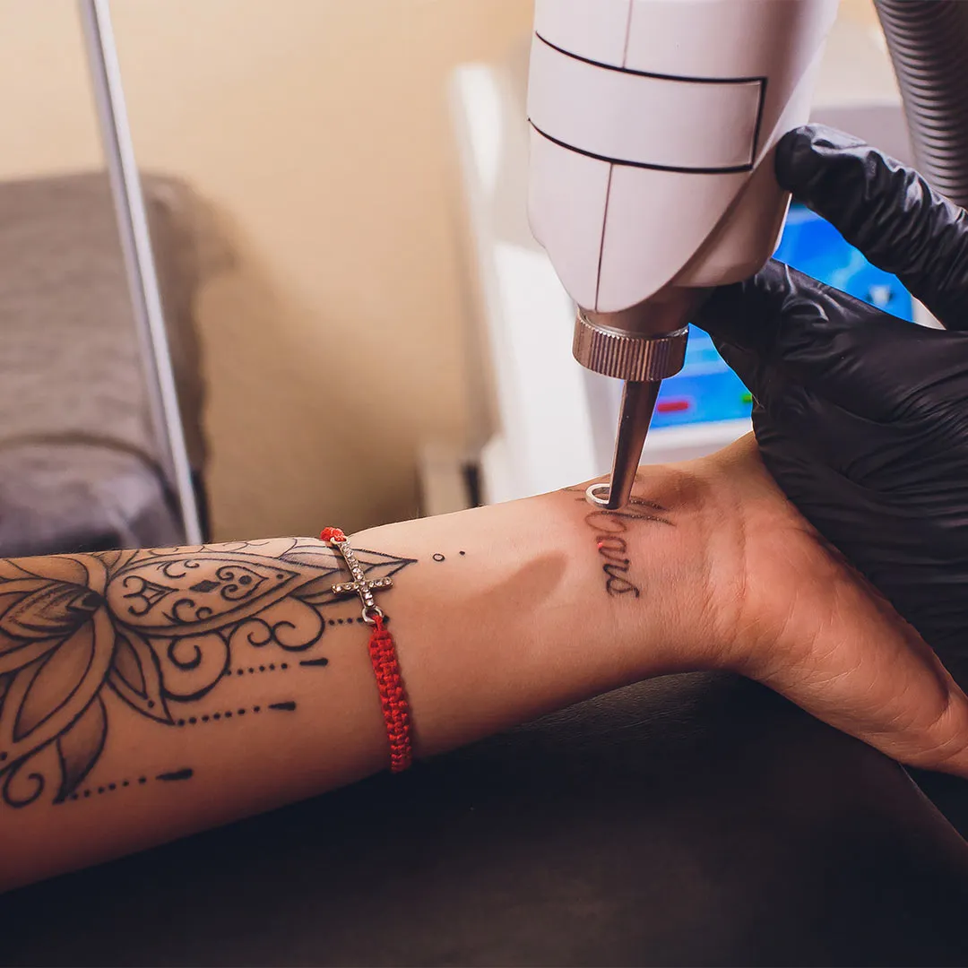 Tattoo Removal