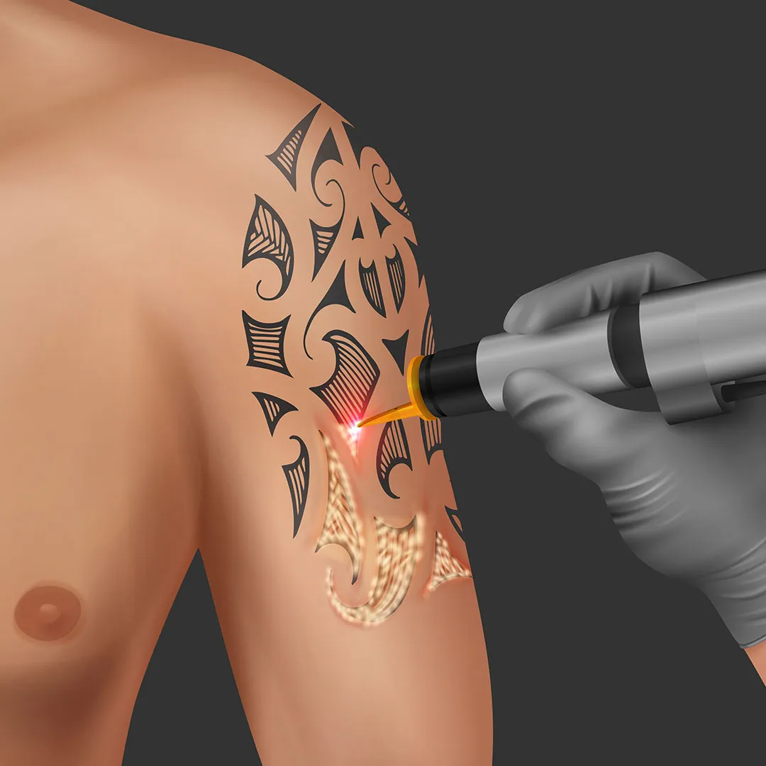 Customization For Tattoo Ink Removal