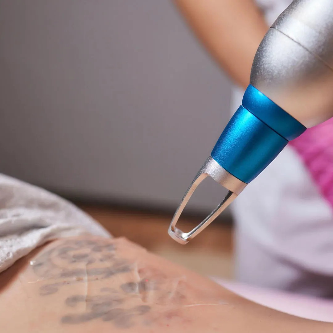 Tattoo Removal With Laser