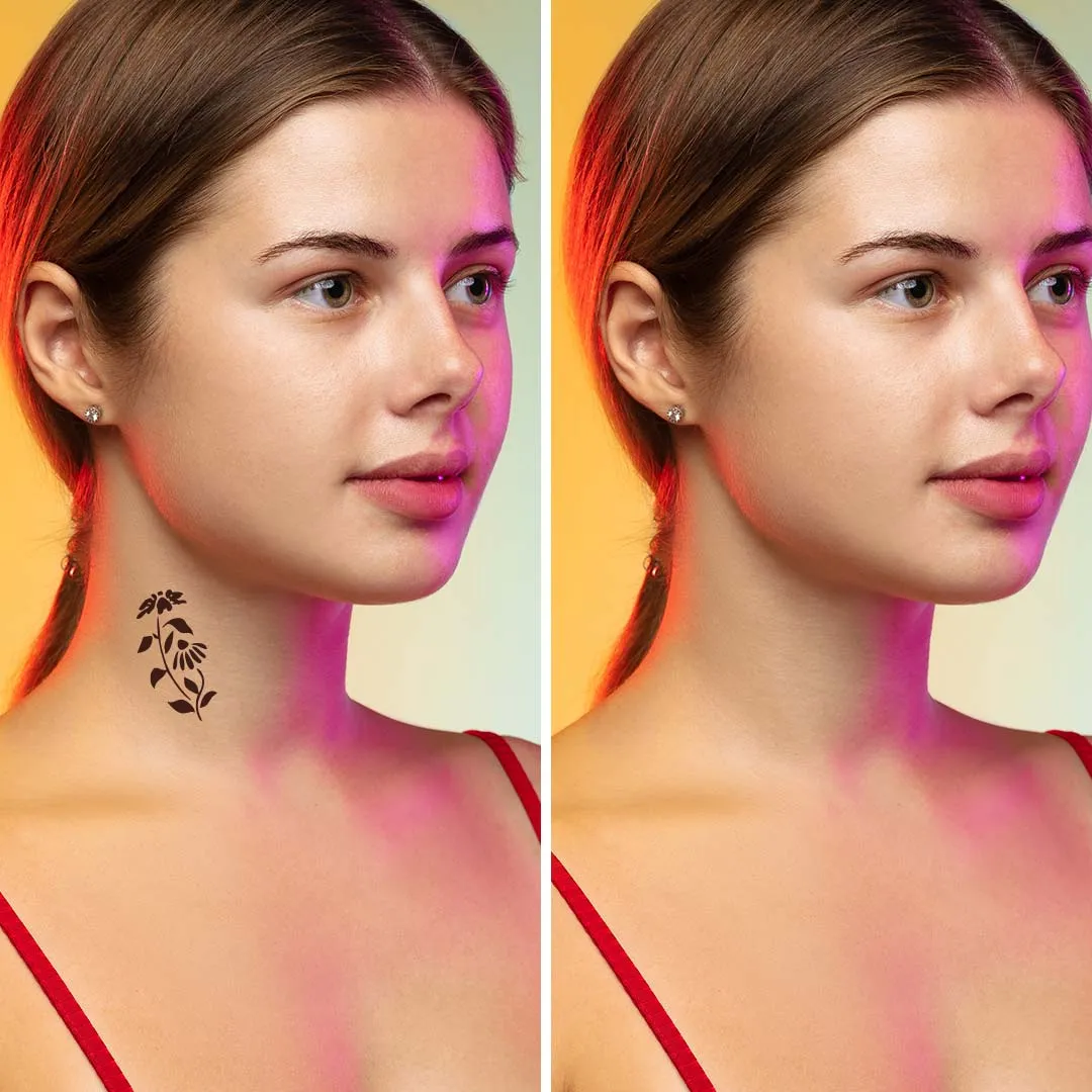 Tattoo Ink Removal Before And After