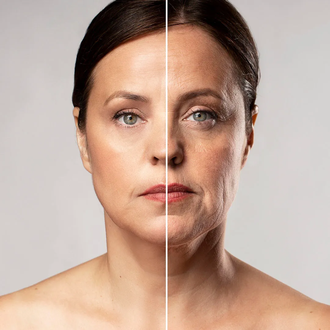 Transformation After Fine Lines Removal With Botox