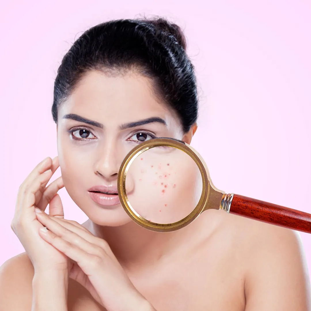 Acne Spot Removal