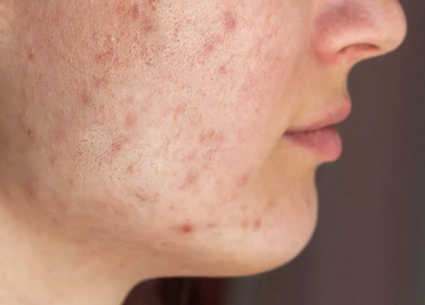 Affordable Acne Scars Removal in Dhaka