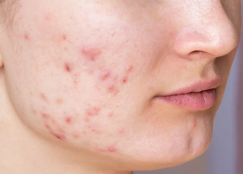 Acne Spot Removal