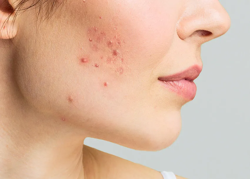 Affordable Treatment for Pimples Spot