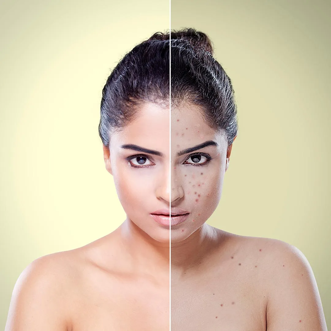 PRP Facial Treatment