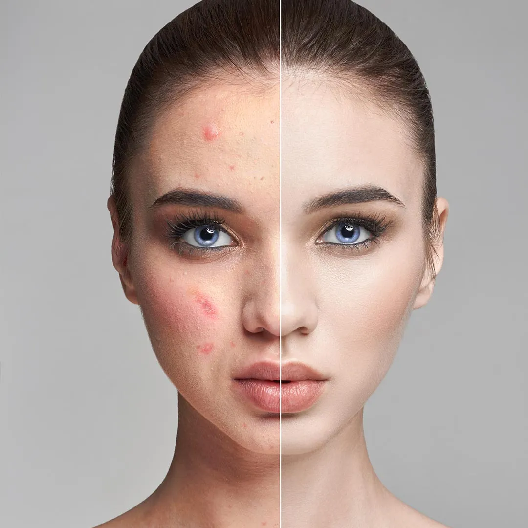 PRP Facial Treatment