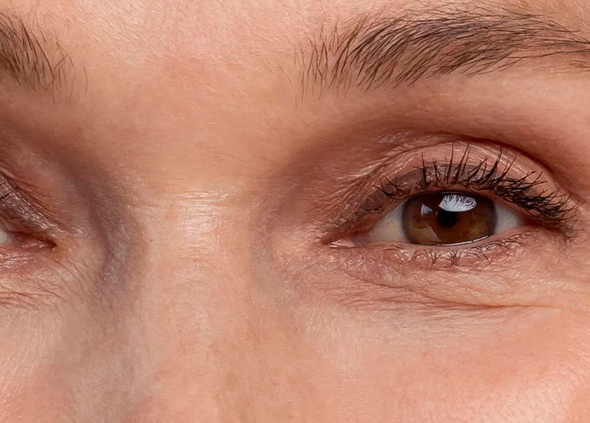 Fractional Laser Resurfacing