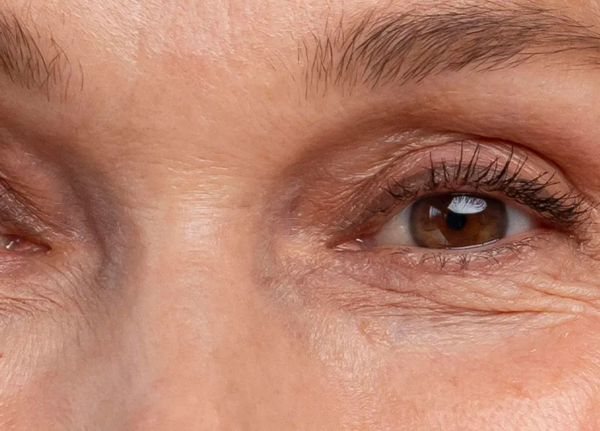 Co2 Laser Resurfacing Under Eyes