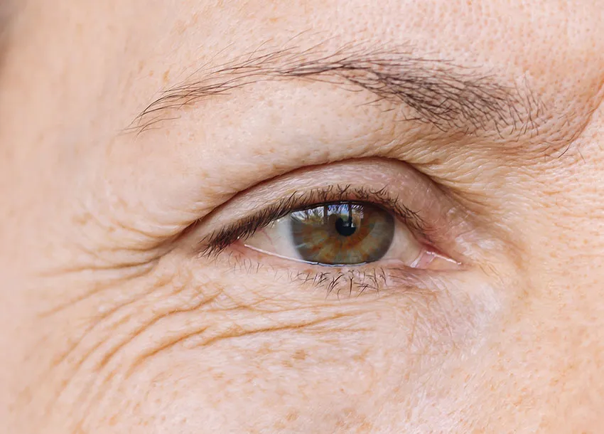 Affordable Fractional Laser Treatment in Dhaka