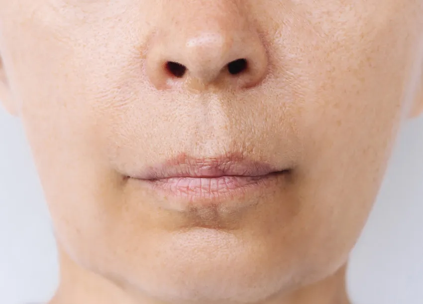 Fractional Co2 Laser Benefits