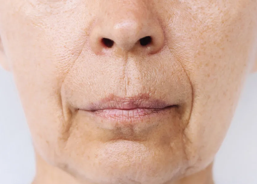 Fractional Co2 Laser Benefits