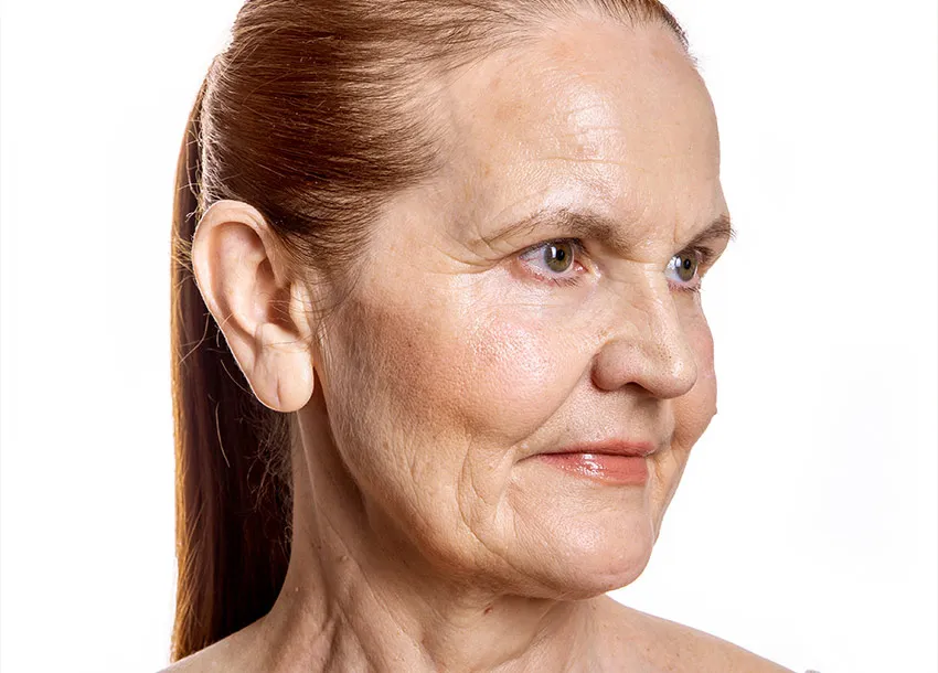Best Carbon-dioxide Laser Treatment
