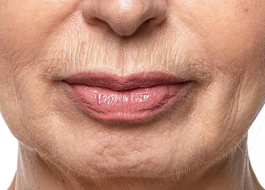 Fractional Laser Treatment