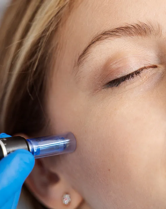 CO2 Laser Resurfacing