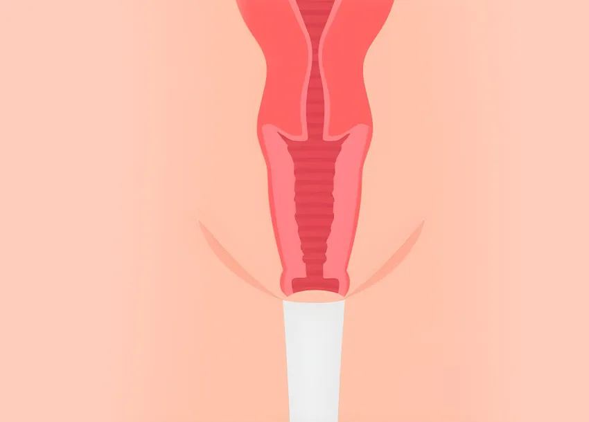 Vaginal Tightening Review in Dhaka
