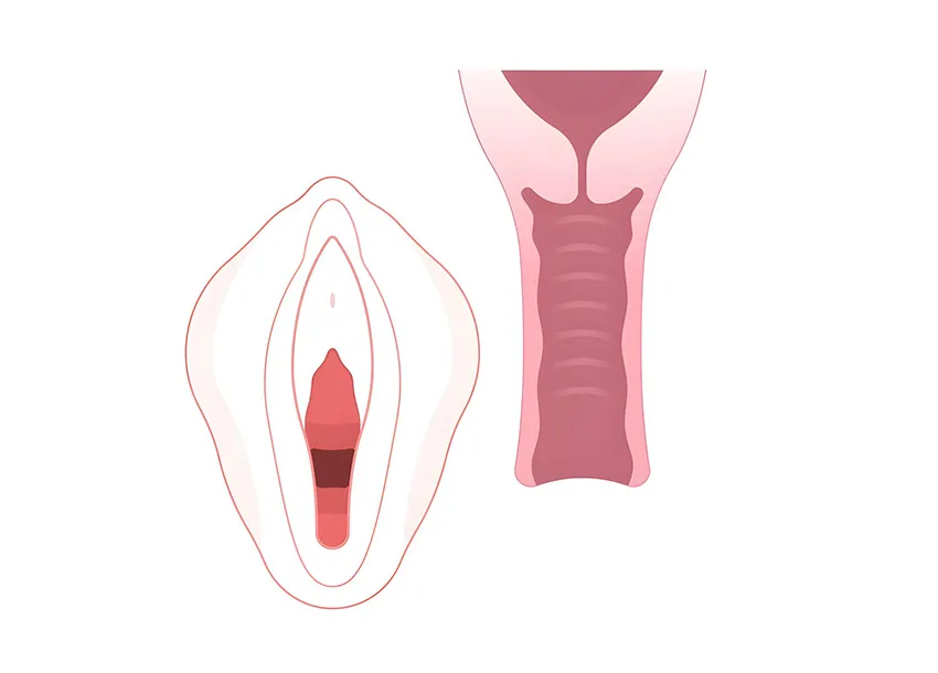 Laser Vaginal Tightening