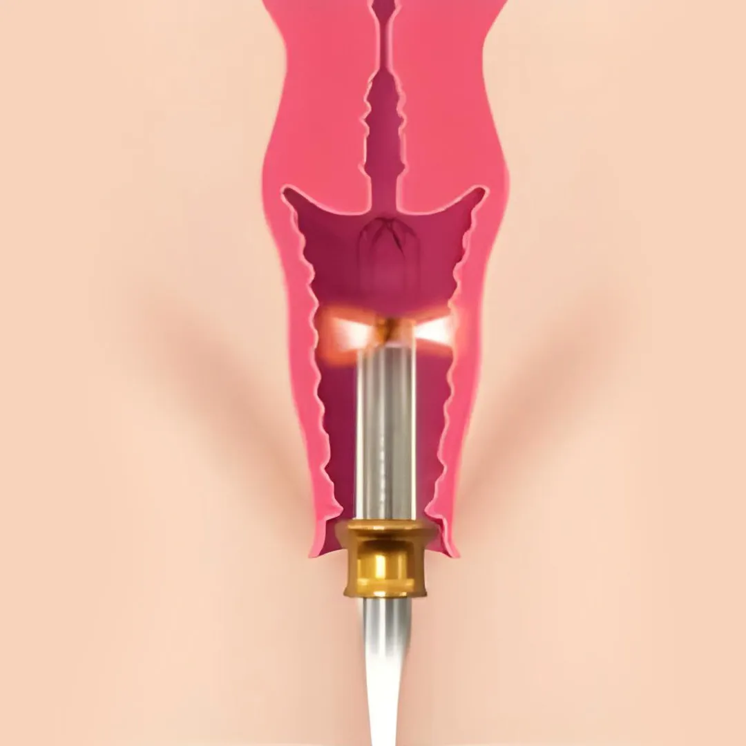 Vaginal Tightening Treatment
