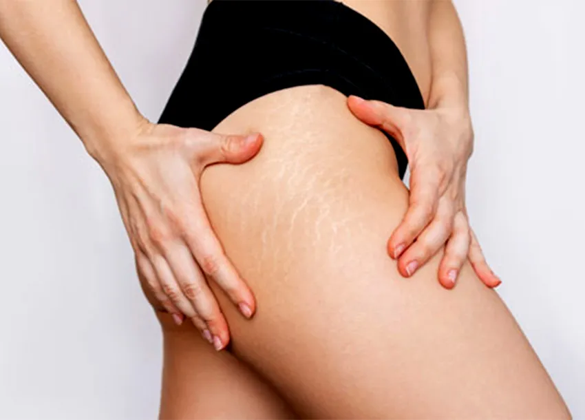 Stretch Mark Remove