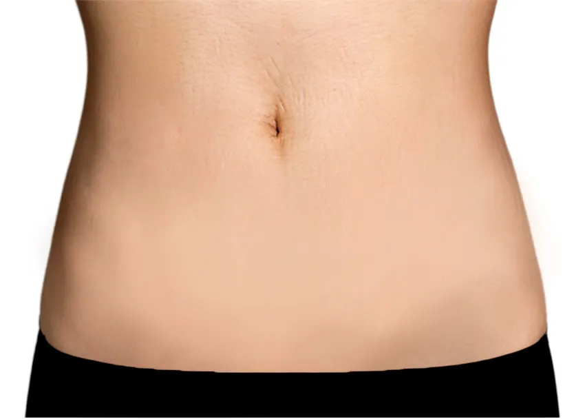 Belly Button Stretch Mark Removal