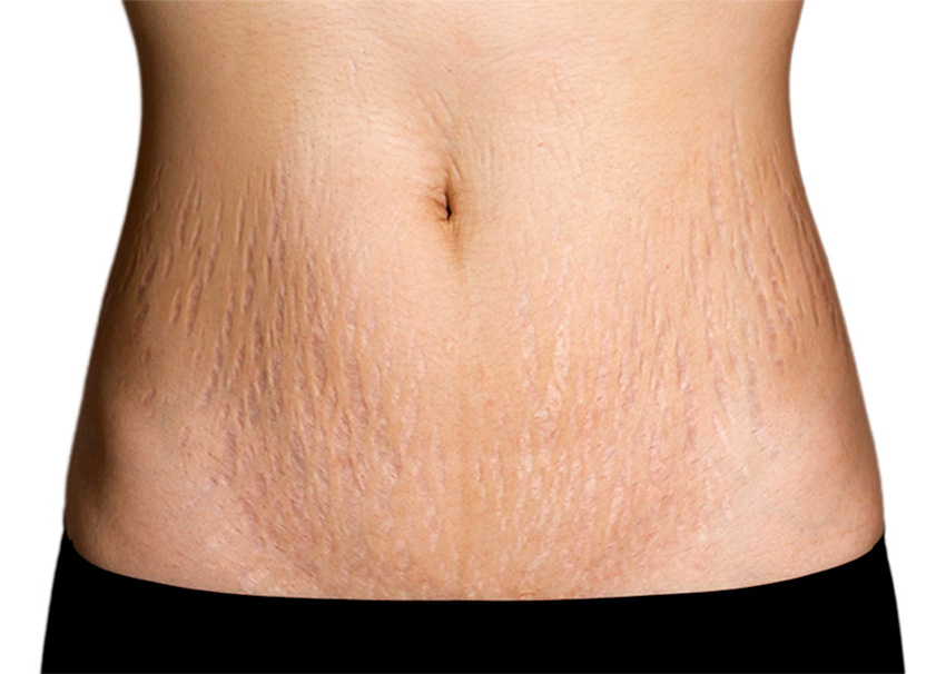 Belly Button Stretch Mark Removal