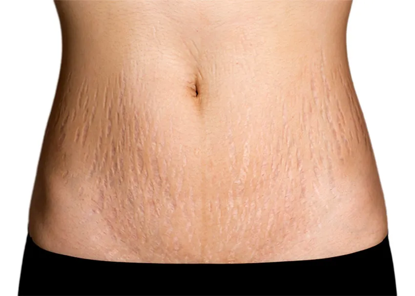 Belly Button Stretch Mark Removal