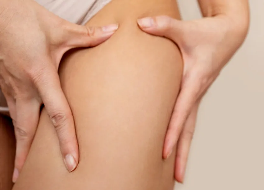 Affordable Striae Gravidarum Treatment