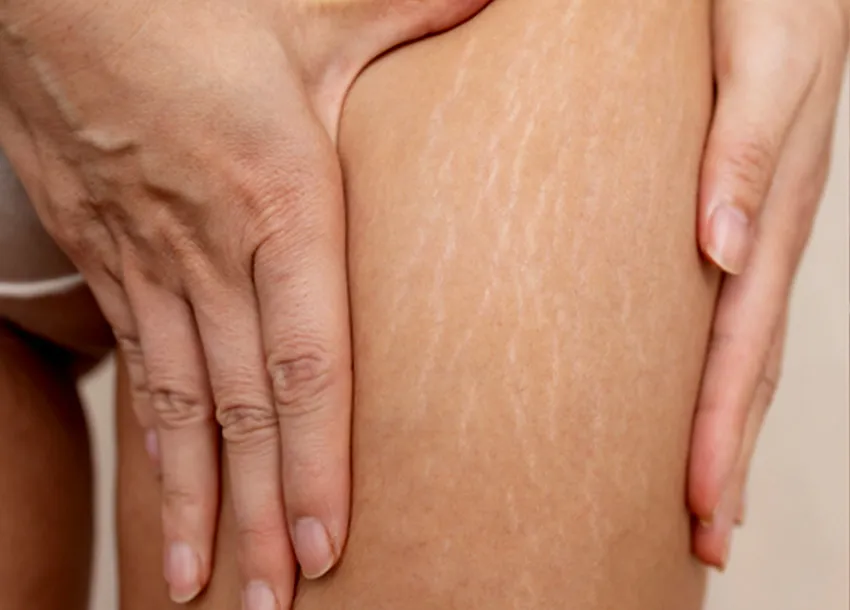 Striae Gravidarum Colour