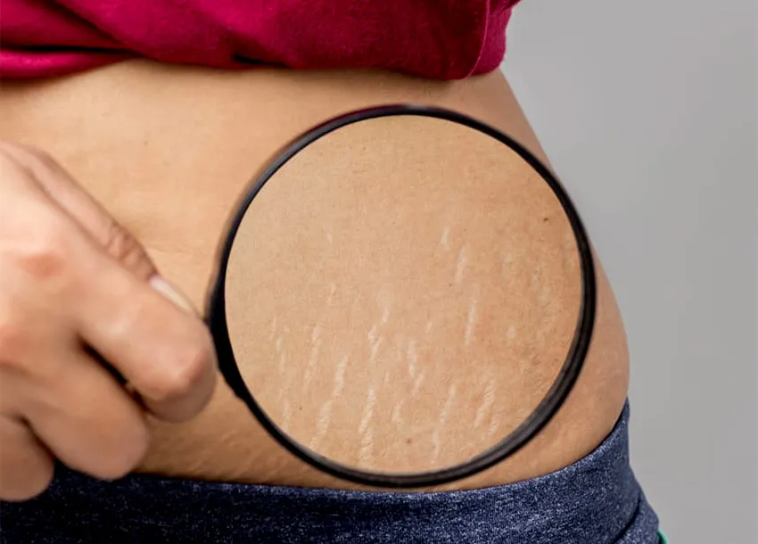 Best Belly Mark Remove Service
